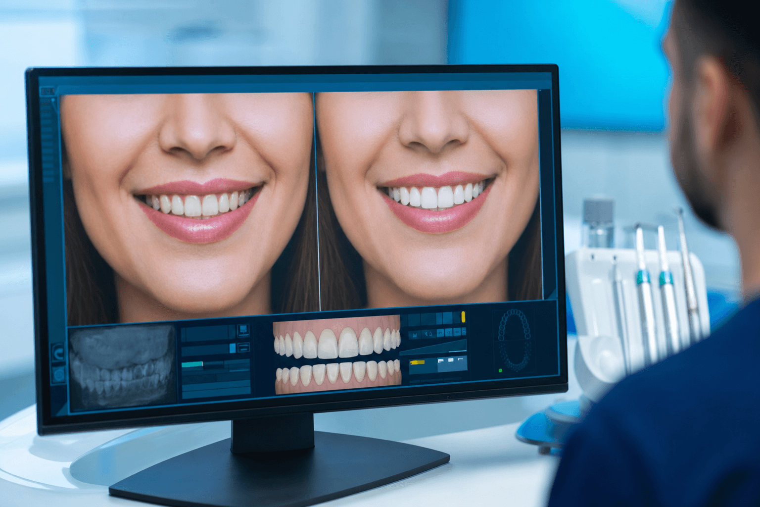 Simulazione digitale del nuovo sorriso prima del trattamento